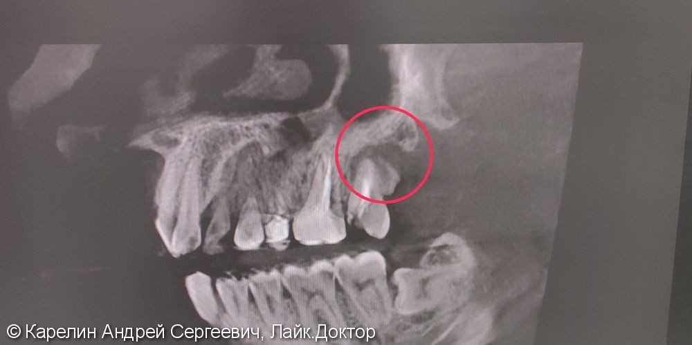 Лечение периодонтита зуба 2.7 с распломбировкой каналов - фото №1