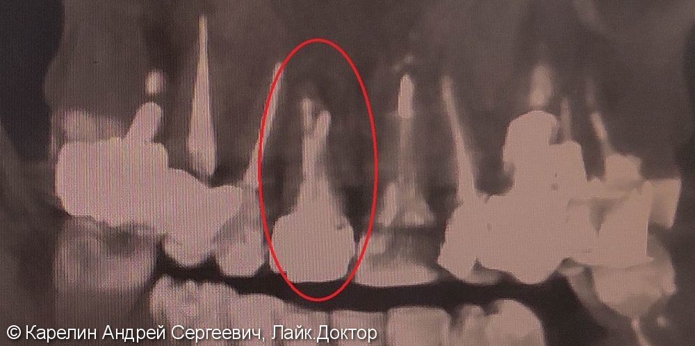 Одномоментная с удалением имплантация зуба 1.1 с немедленной нагрузкой временной коронкой - фото №2