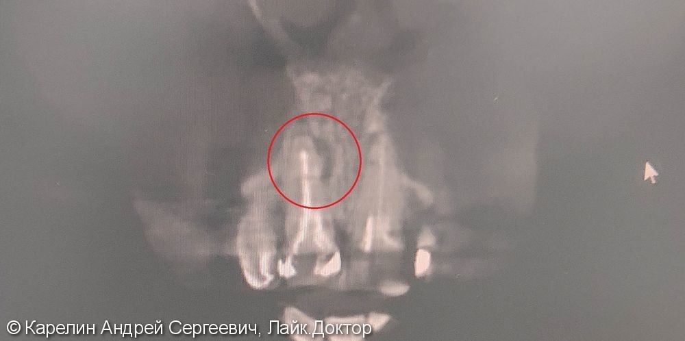 Одномоментная с удалением имплантация зуба 1.1 с немедленной нагрузкой временной коронкой - фото №4