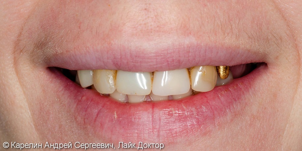 Одномоментная с удалением имплантация зуба 1.1 с немедленной нагрузкой временной коронкой - фото №5