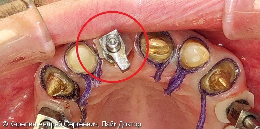 Одномоментная с удалением имплантация зуба 1.1 с немедленной нагрузкой временной коронкой - фото №6