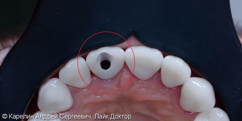 Одномоментная с удалением имплантация зуба 1.1 с немедленной нагрузкой временной коронкой - фото №7