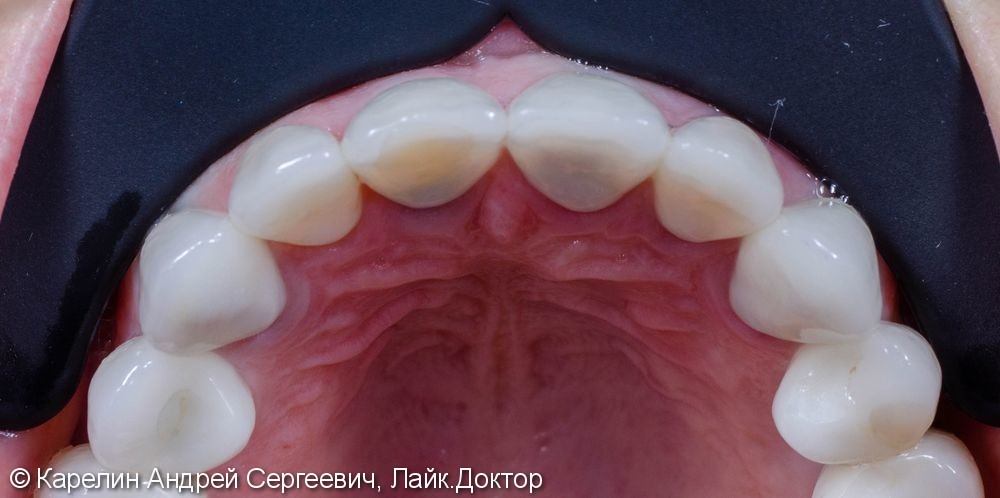 Одномоментная с удалением имплантация зуба 1.1 с немедленной нагрузкой временной коронкой - фото №8