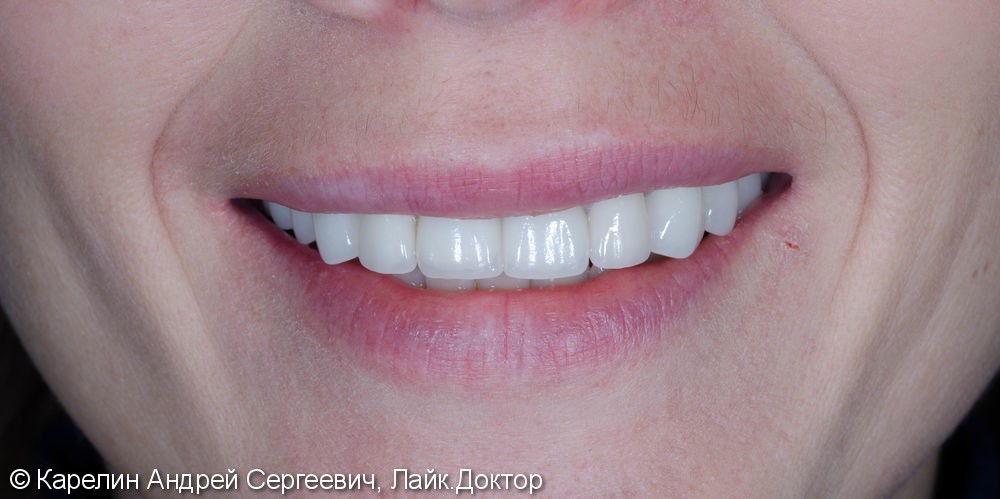 Одномоментная с удалением имплантация зуба 1.1 с немедленной нагрузкой временной коронкой - фото №9