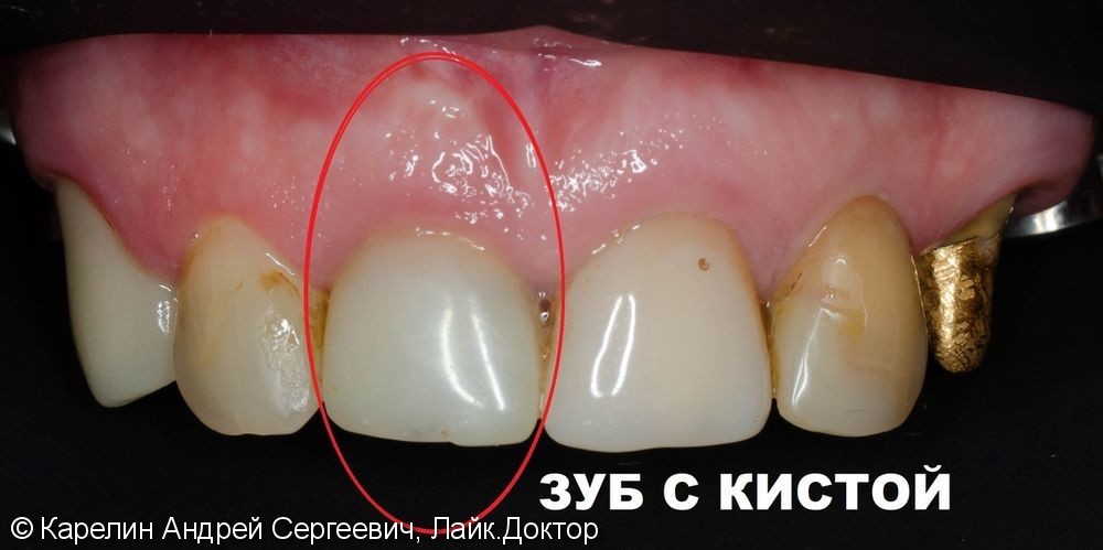 Одномоментная с удалением имплантация зуба 1.1 с немедленной нагрузкой временной коронкой - фото №1