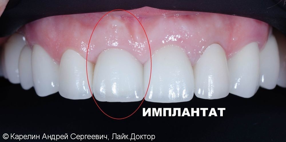 Одномоментная с удалением имплантация зуба 1.1 с немедленной нагрузкой временной коронкой - фото №10