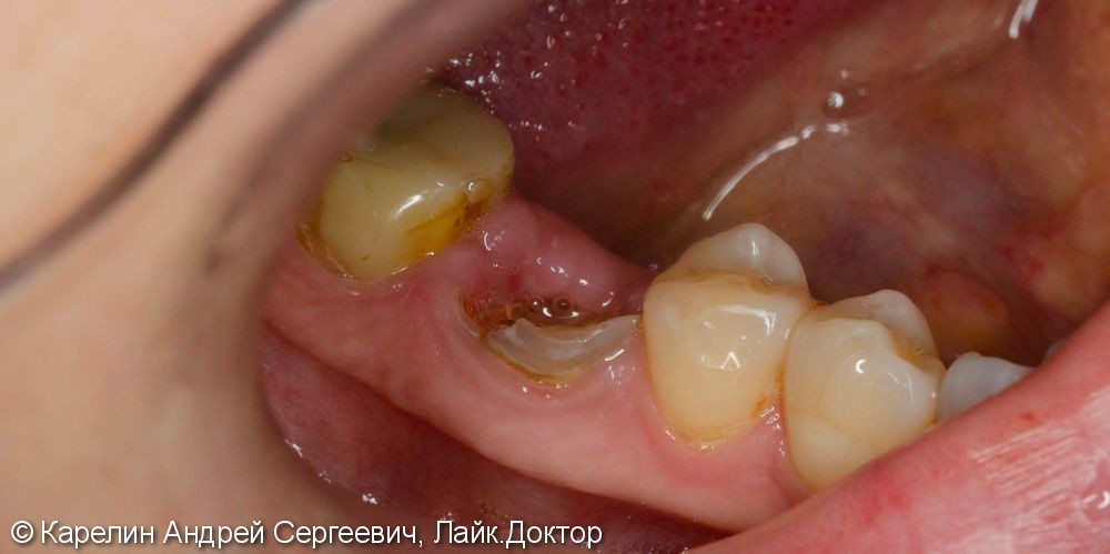 Одномоментная имплантация зуба 4.6 - фото №1