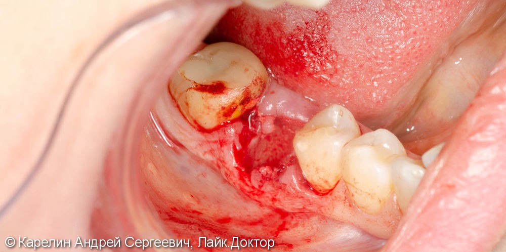 Одномоментная имплантация зуба 4.6 - фото №3