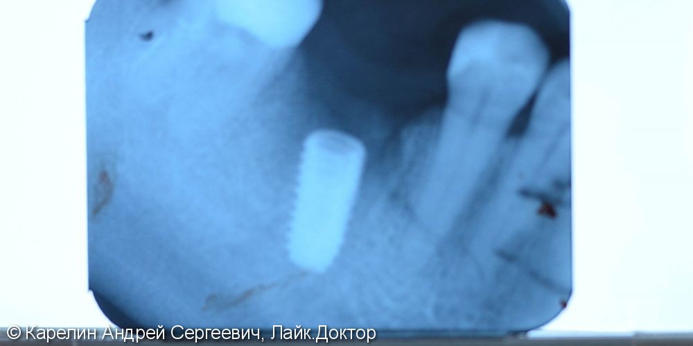 Одномоментная имплантация зуба 4.6 - фото №5