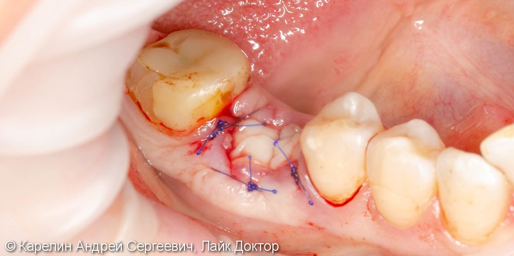 Одномоментная имплантация зуба 4.6 - фото №6