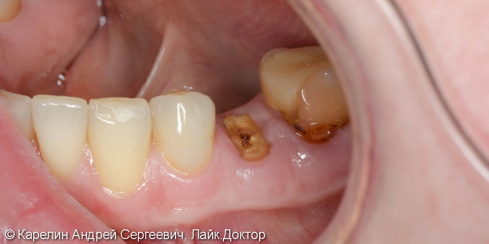 Одномоментная имплантация зуба 4.5 с немедленной частичной нагрузкой через формирователь десны - фото №1