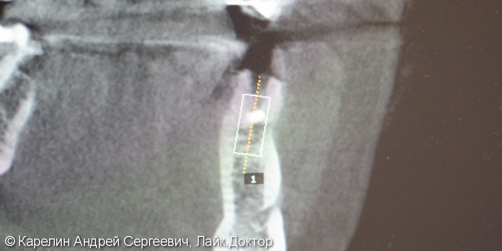 Одномоментная имплантация зуба 4.5 с немедленной частичной нагрузкой через формирователь десны - фото №2