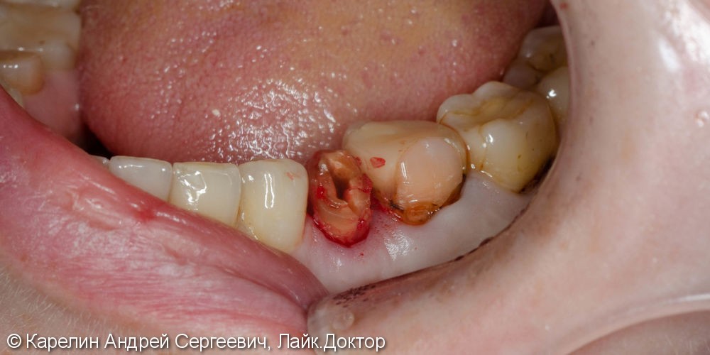 Одномоментная имплантация зуба 4.5 с немедленной частичной нагрузкой через формирователь десны - фото №3