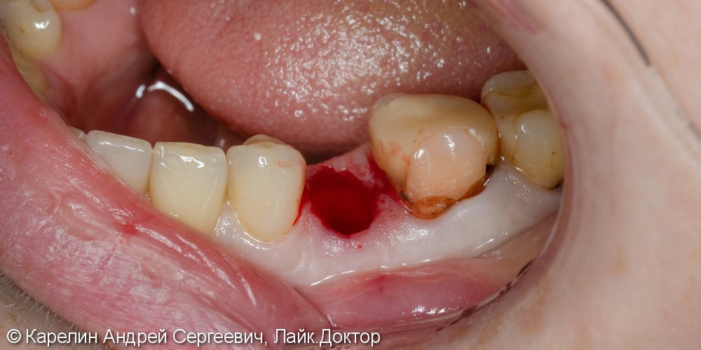 Одномоментная имплантация зуба 4.5 с немедленной частичной нагрузкой через формирователь десны - фото №4