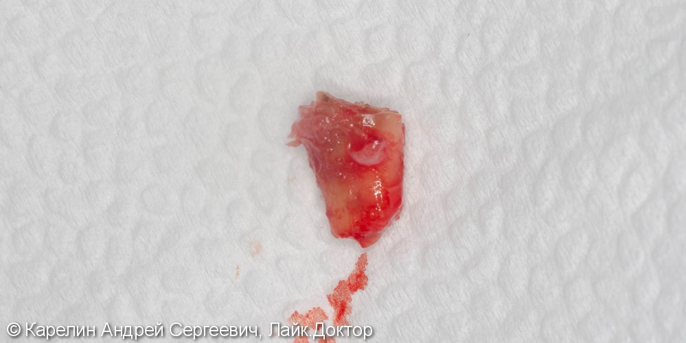 Одномоментная имплантация зуба 4.5 с немедленной частичной нагрузкой через формирователь десны - фото №5