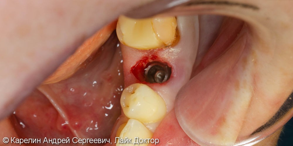 Одномоментная имплантация зуба 4.5 с немедленной частичной нагрузкой через формирователь десны - фото №6