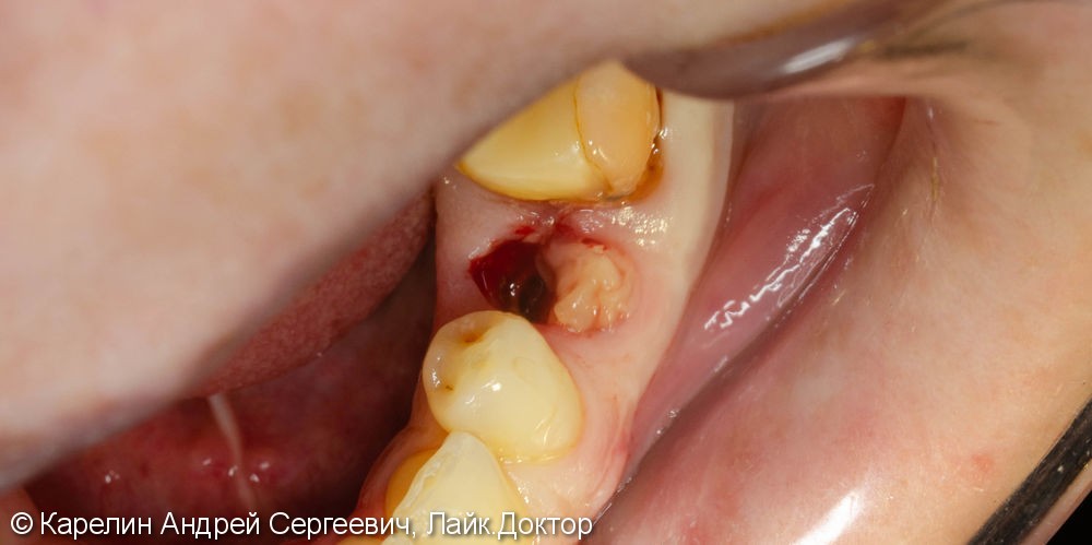 Одномоментная имплантация зуба 4.5 с немедленной частичной нагрузкой через формирователь десны - фото №7