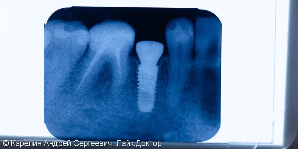 Одномоментная имплантация зуба 4.5 с немедленной частичной нагрузкой через формирователь десны - фото №8