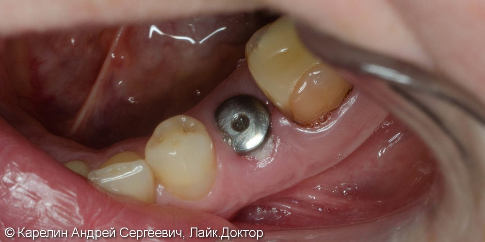 Одномоментная имплантация зуба 4.5 с немедленной частичной нагрузкой через формирователь десны - фото №9