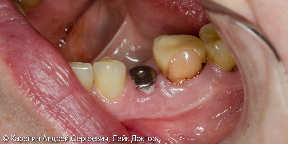 Одномоментная имплантация зуба 4.5 с немедленной частичной нагрузкой через формирователь десны - фото №10