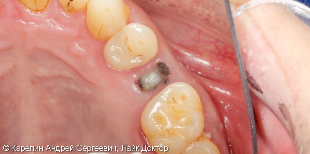 Одномоментная имплантация зуба 1.5 с частичной немедленной нагрузкой через формирователь десны - фото №1