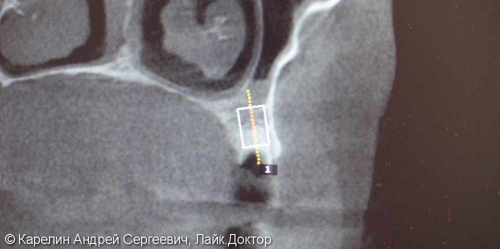 Одномоментная имплантация зуба 1.5 с частичной немедленной нагрузкой через формирователь десны - фото №2