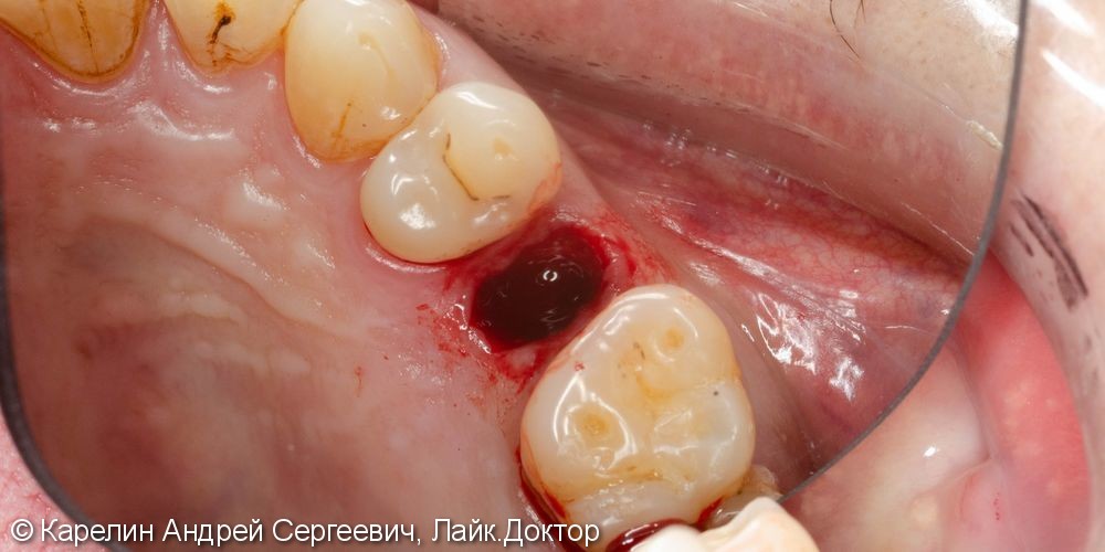 Одномоментная имплантация зуба 1.5 с частичной немедленной нагрузкой через формирователь десны - фото №3