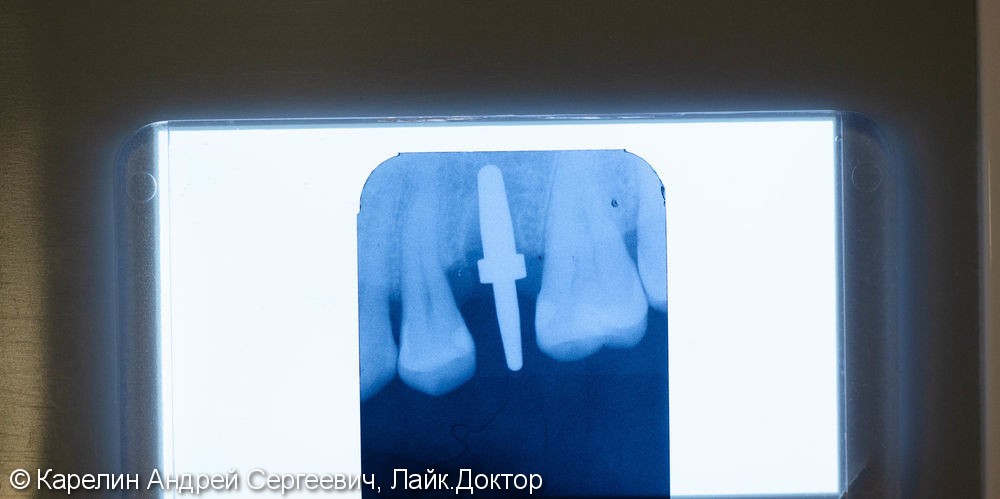 Одномоментная имплантация зуба 1.5 с частичной немедленной нагрузкой через формирователь десны - фото №5