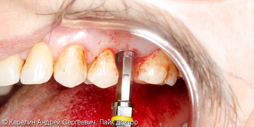 Одномоментная имплантация зуба 1.5 с частичной немедленной нагрузкой через формирователь десны - фото №6
