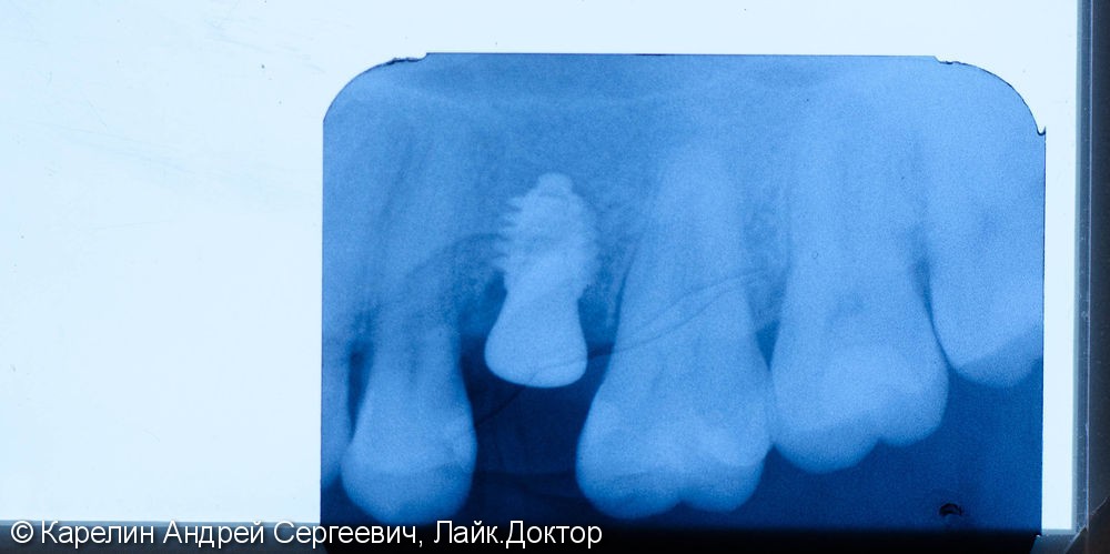 Одномоментная имплантация зуба 1.5 с частичной немедленной нагрузкой через формирователь десны - фото №8