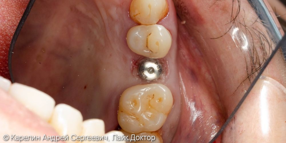 Одномоментная имплантация зуба 1.5 с частичной немедленной нагрузкой через формирователь десны - фото №9