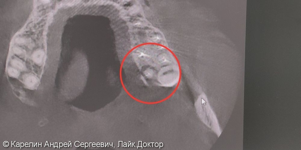Лечение периодонтита зуба 2.7 с распломбировкой каналов - фото №4