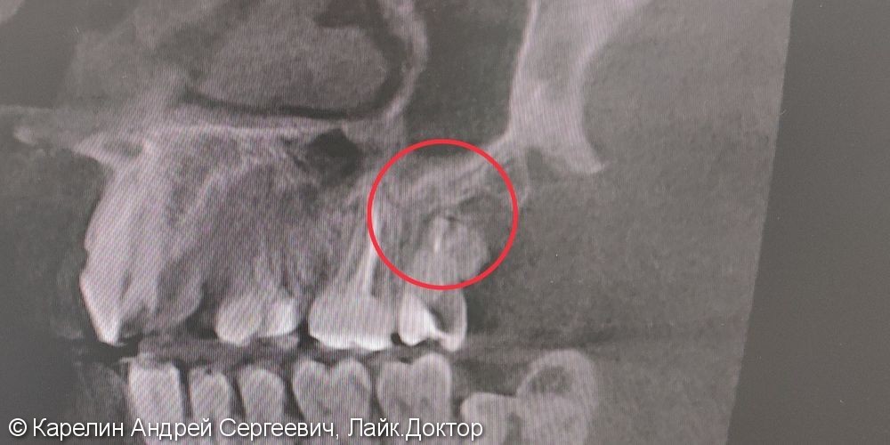 Лечение периодонтита зуба 2.7 с распломбировкой каналов - фото №6