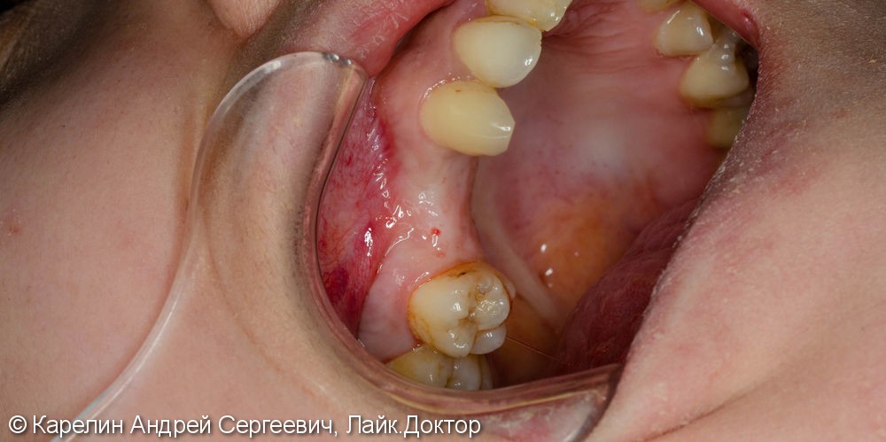 Имплантация в области 1.4,1.5 зубов - фото №1