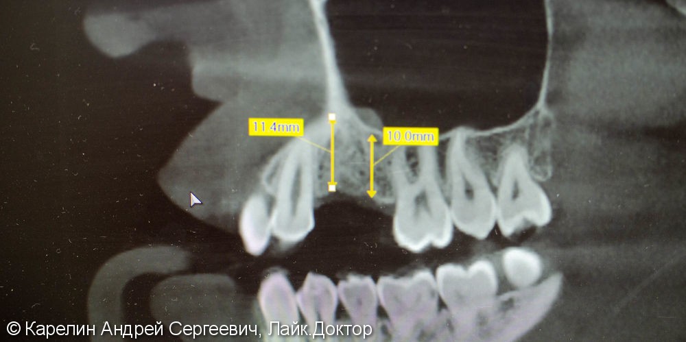 Имплантация в области 1.4,1.5 зубов - фото №2
