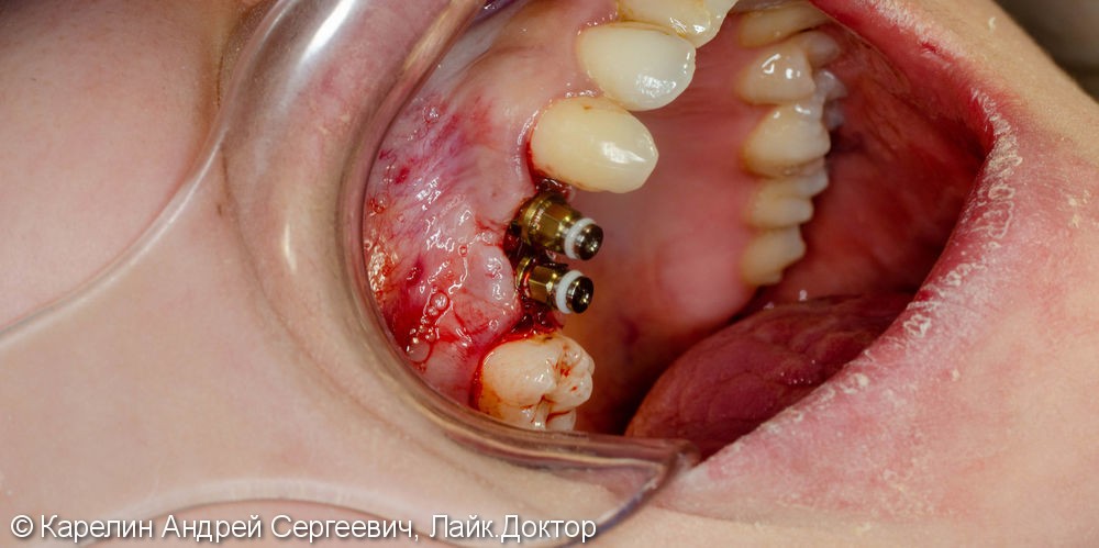 Имплантация в области 1.4,1.5 зубов - фото №3