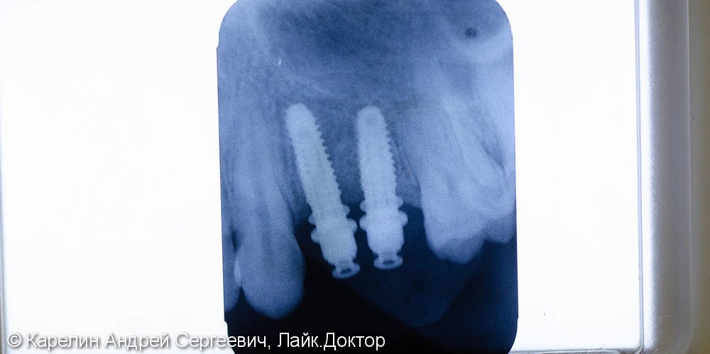 Имплантация в области 1.4,1.5 зубов - фото №4