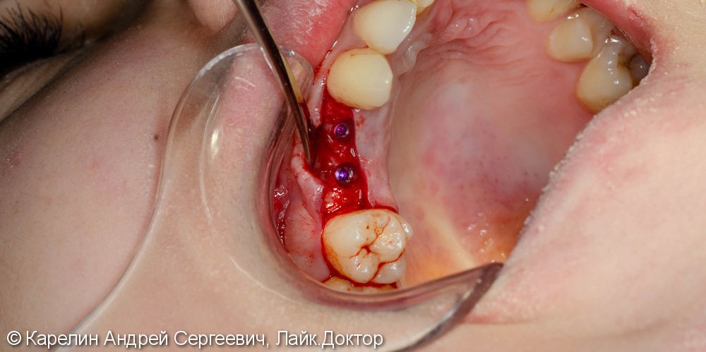 Имплантация в области 1.4,1.5 зубов - фото №5