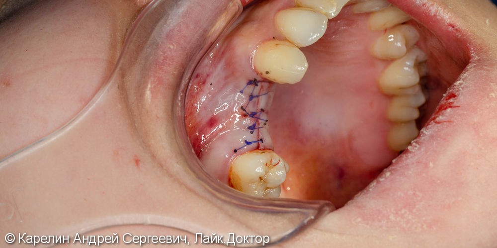 Имплантация в области 1.4,1.5 зубов - фото №6