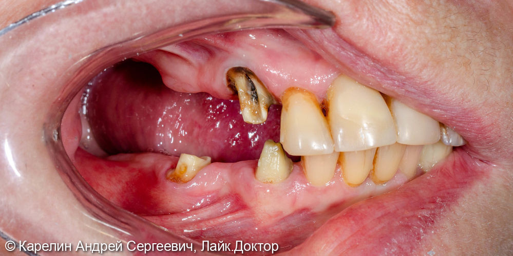 Тотальное протезирование обеих челюстей с помощью металлокерамических коронок и бюгельных протезов - фото №3