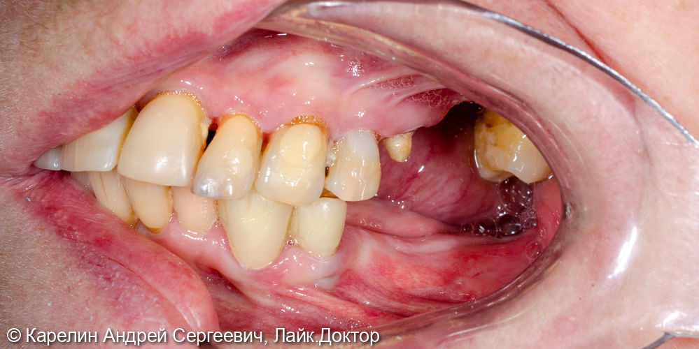 Тотальное протезирование обеих челюстей с помощью металлокерамических коронок и бюгельных протезов - фото №4