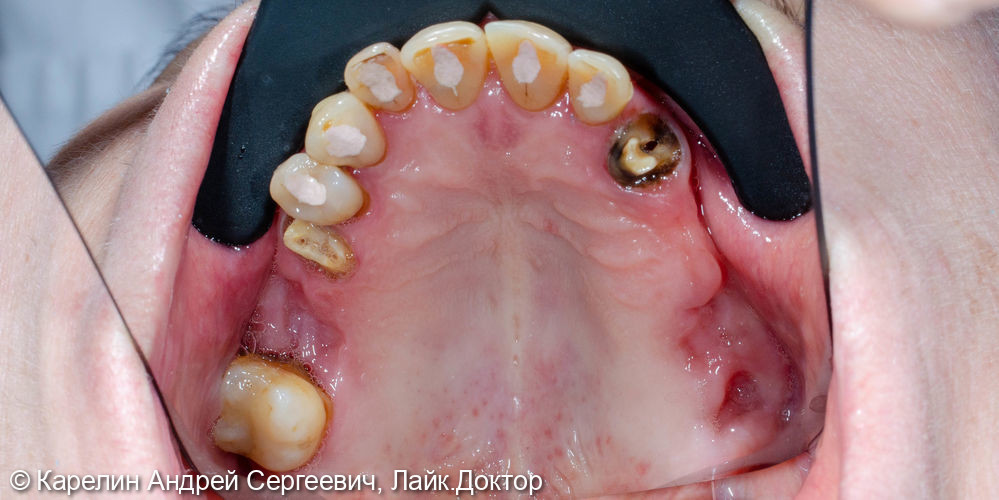 Тотальное протезирование обеих челюстей с помощью металлокерамических коронок и бюгельных протезов - фото №5