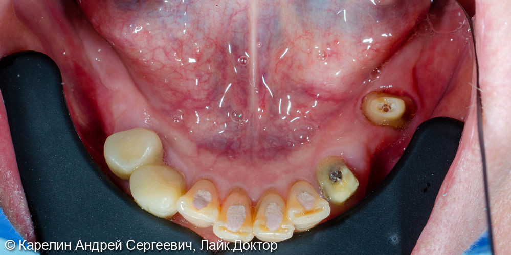Тотальное протезирование обеих челюстей с помощью металлокерамических коронок и бюгельных протезов - фото №6
