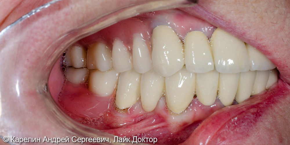 Тотальное протезирование обеих челюстей с помощью металлокерамических коронок и бюгельных протезов - фото №15