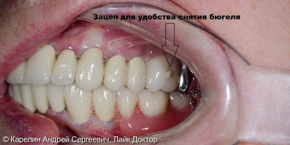 Тотальное протезирование обеих челюстей с помощью металлокерамических коронок и бюгельных протезов - фото №17