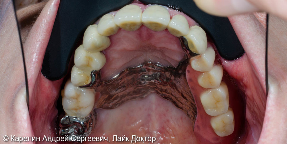 Тотальное протезирование обеих челюстей с помощью металлокерамических коронок и бюгельных протезов - фото №18