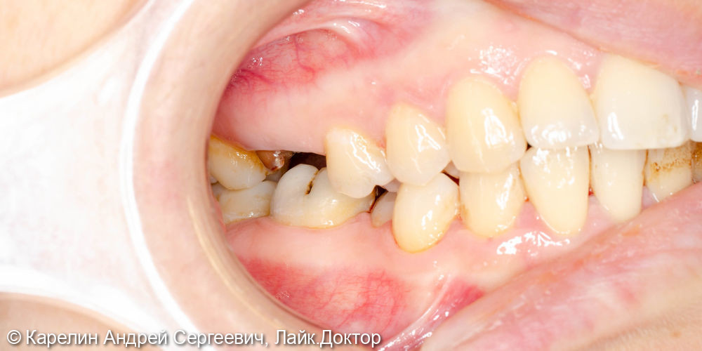 Одномоментная с удалением имплантация в области зуба 4.6 - фото №2