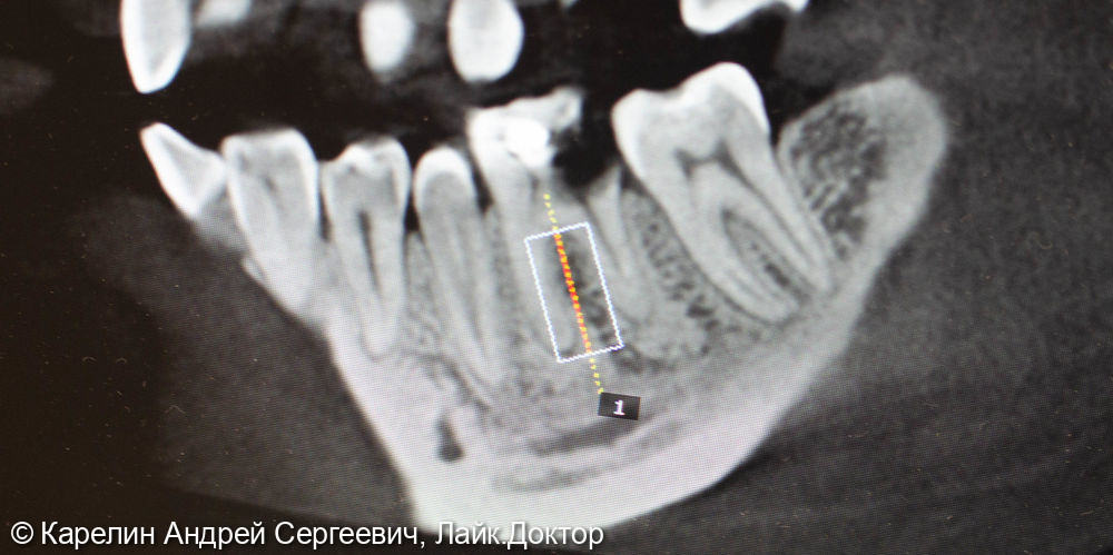 Одномоментная с удалением имплантация в области зуба 4.6 - фото №3