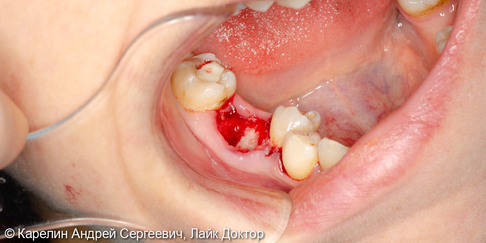 Одномоментная с удалением имплантация в области зуба 4.6 - фото №4