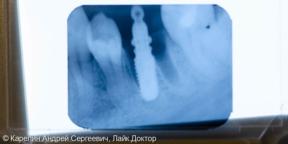 Одномоментная с удалением имплантация в области зуба 4.6 - фото №6